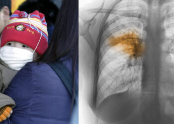 lungenentzündungen in china